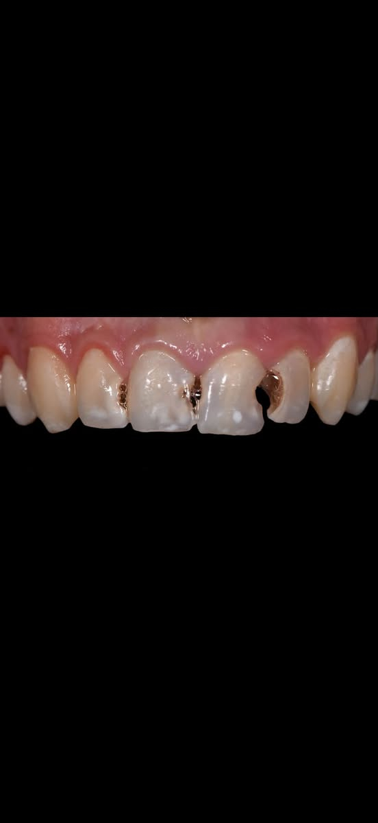 ⁨ ⁨ حشوات تجميلية بلون الأسنان، تعالج التسوس وتحافظ على شكل الابتسامة الطبيعي ✨

لأن التفاصيل الصغيرة تصنع فرق كبير⁩

احجز موعدك الآن! 🦷✨

***********
 ***********
‎📍 العنوان:
‎  المنصور - 14 رمضان - فرع هيل وزعفران

#حشوات #يوميات  #اسنان  #اكسبلورexplore⁩⁩⁩⁩⁩⁩

