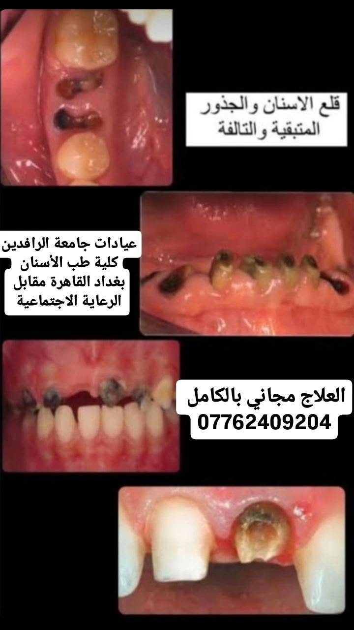 علاج مجاني • قلع أسنان • بغداد القاهرة