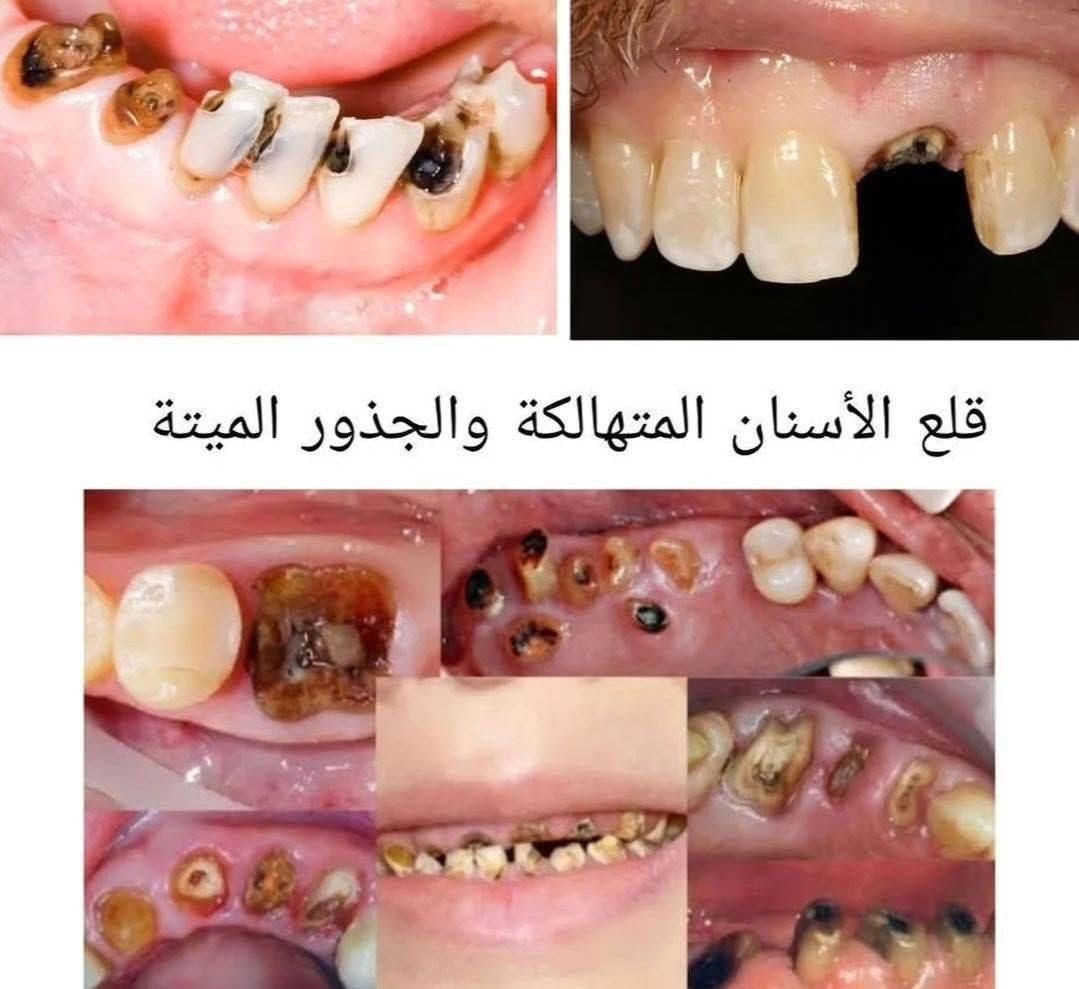 نستقبل الحالات التالية مجانا بحجز مسبق:
-تنظيف الاسنان من التكلسات وتصبغات 

-قلع الأسنان التالفة والجذور المتبقية 

- حشوات ضوئية دائمية للاسنان الأمامية والخلفية 

- علاج اسنان الاطفال  من عمر ٥ سنوات الى ١٤ سنة (حشوات-قلع جلسات الوقاية من التسوس للاطفال)
حشوات وقلع الاسنان اللبنية للاطفال 🦷👼🏻 

-عمل طقم اسنان كامل لتعويض الاسنان المفقودة (شرط الشخص فاقد جميع اسنانه العلوية والسفلية) لعمل طقم مرن للفكين 

ملاحظة: عمل الطبيب مجاني ✨ 
ملاحظة: يتوفر كادر طب اسنان نسائي مختص 
والعلاج تحت اشراف اطباء اختصاص وبشكل مجاني بالكامل ولعدد محدود 

للحجز والاستفسار: مراسلة الرقم على الواتساب ***********

العنوان: كربلاء المقدسة / طريق الحر / عيادات طب الاسنان في جامعة اهل البيت عليهم السلام
