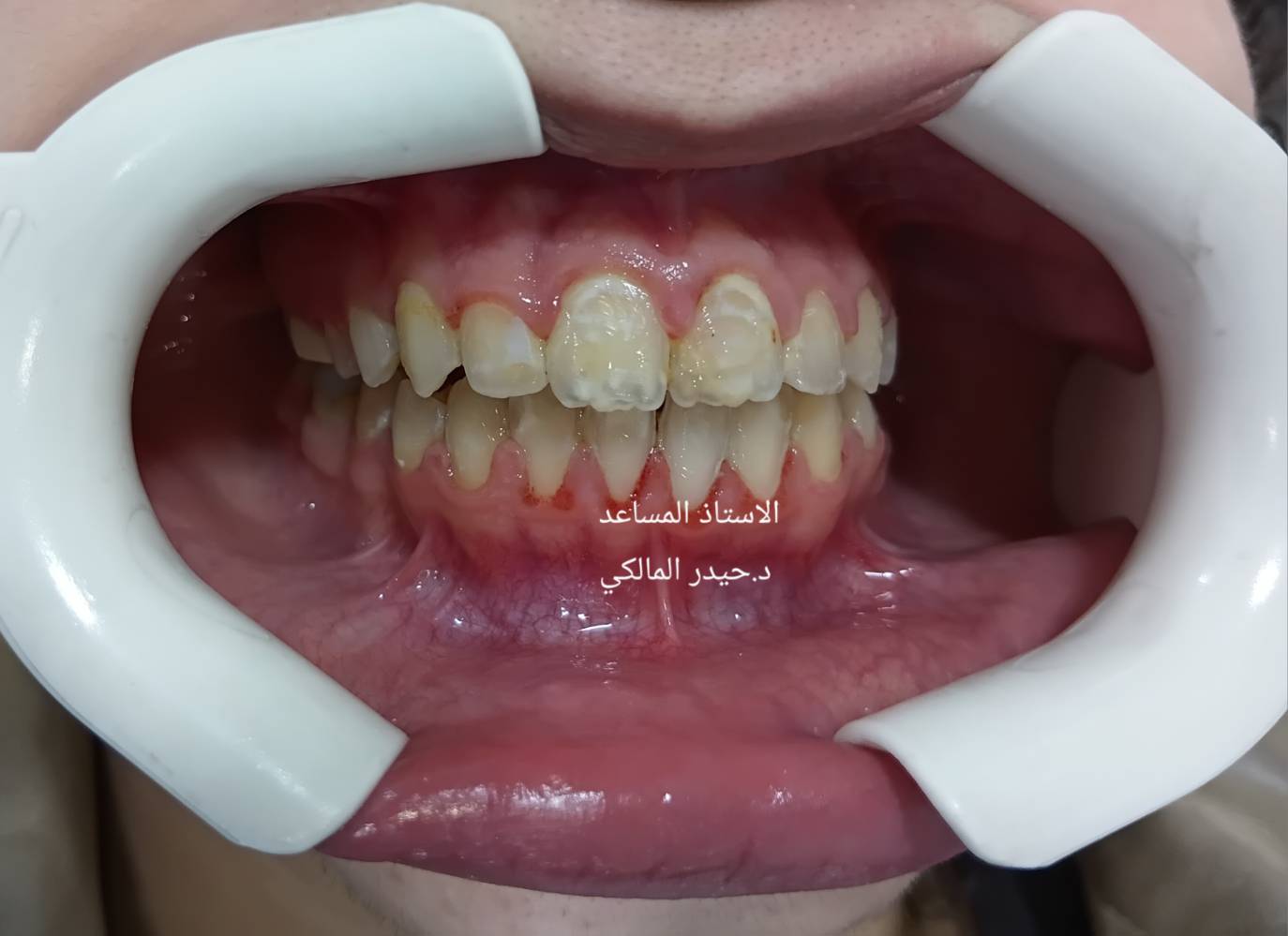 تقويم أسنان • بالتقسيط • شارع فلسطين