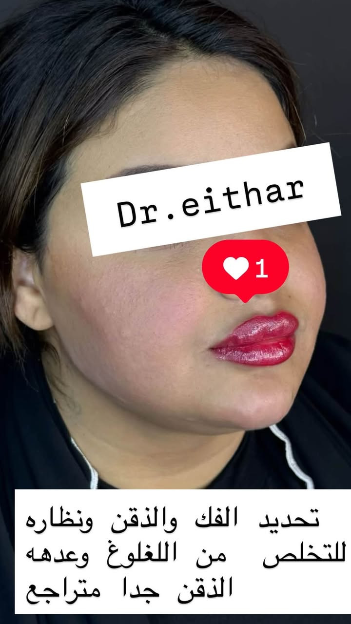 كونتور الوجه بالفلر  (لفتنك وجنات وتدوير الفك والذقن ونظاره) 🔥🔥
لاحضو الفرق بالذقن ومنطقه الفك شكد تغير الشكل🔥
عروووض فرحة الزهره ثبتتهه الكم بالستوري بالهايلايت وببوست اعلى الصفحة ✨✨

د.ايثار سامي عبد الامير
واسط الكوت الهوره مجمع القبطان طابق اول 

الحجز***********
