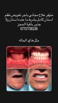 علاج مجاني • طقم اسنان كامل • بدون جذور