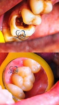 حشوة ضوئية تجميلية • عيادة لانا • عفك