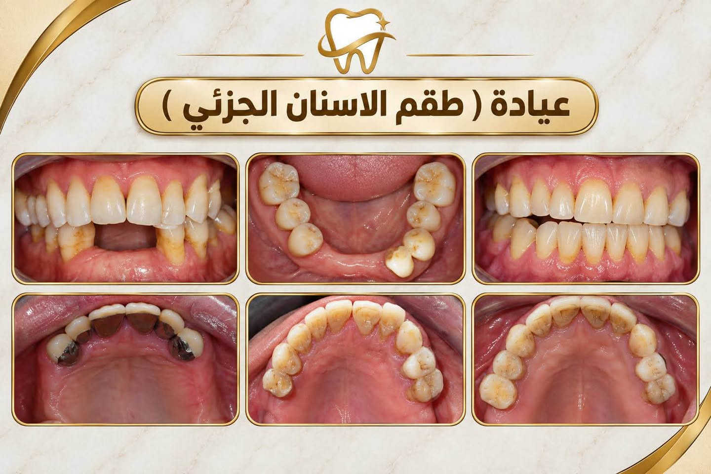 الـسلام عليكم
العلاج مجـاني  بالكامل 
متوفر قلع الاسنان التالفة وبقايا الجذور وتعويضها بطقم متحرك تنظيف حشوات ضوئية كلشي معقم ونظيف تحت اشراف اطباء مختصين

نص مكتوب في الصور:
- دكتورة زينب فرحان طالبة طب وجراحة الفم والأسنان الخدمات المتوفرة قلع الأسنان حشوات تجميلية تركيب طقم أسنان تنظيف الأسنان مكان العيادة كلية طب الأسنان جامعة دجلة *********** @bk__ares نعني بابتسامتك لأنك تستحق الأفضل
- عيادة تنظيف الاسنان
- عيادة القلع
- عيادة الحشوات
- عيادة ( طقم الاسنان الجزئي )