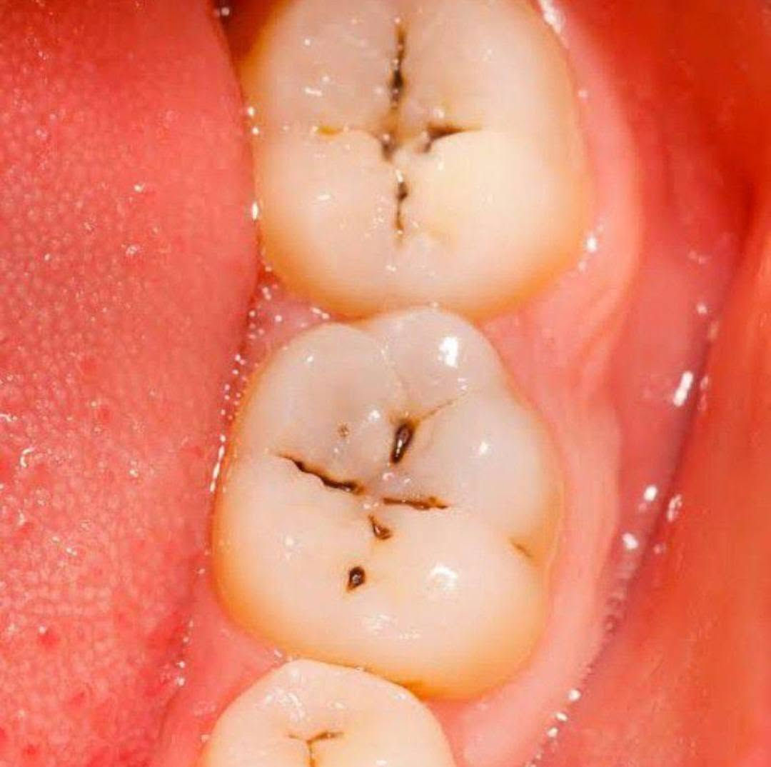 ❣️ علاج مجاني ❣️
حشوات ضوئية تجميلية 
تنظيف الاسنان وازالة التكلسات 
قلع الاسنان التالفة والجذور المتبقية
تعويض الاسنان المفقودة بطقم جزئي متحرك
للاستفسار ***********
📍الدورة نهاية شارع 60
