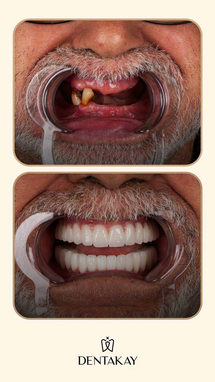🚨🦷 خدمات أسنان مجــــانــــًا بالكامل! 🦷🚨

🎁 فرصة للاستفادة من خدمات طب الأسنان مجانًا:

🦷 طقم أسنان كامل للفك العلوي والسفلي — مجانًا
✨ حشوات ضوئية تجميلية للأسنان الأمامية — مجانًا
🦷 قلع الأسنان — مجانًا
🪥 تنظيف وإزالة تكلسات الأسنان — مجانًا

💥 نعم، الخدمات المذكورة أعلاه مجــــانــــيــــة!

📍 كربلاء – شارع الحر الصغير
🏥 عيادات أهل البيت التخصصية

📞 للحجز والاستفسار:
***********

⏳ الحجز مسبقًا والأماكن محدودة.