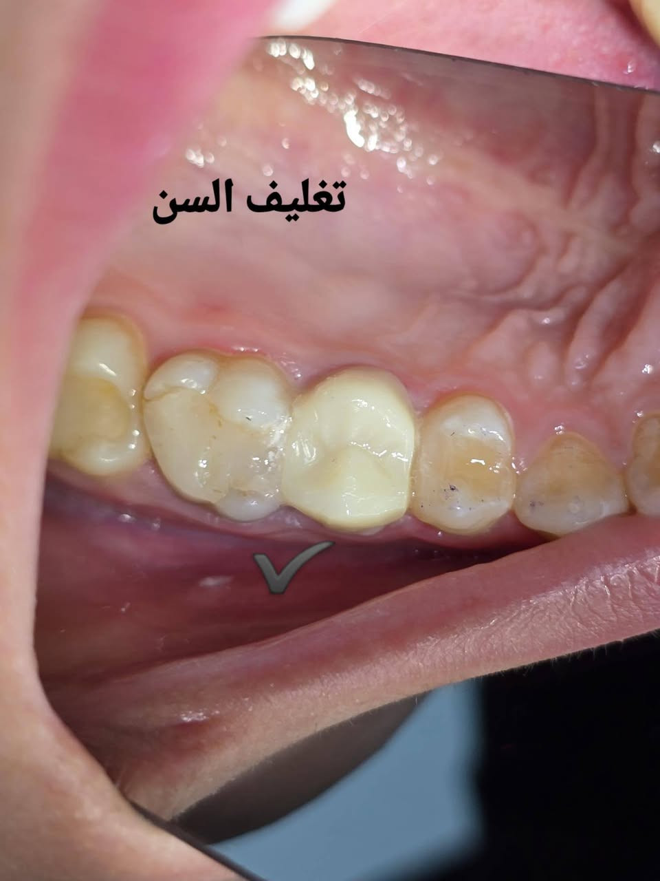 اعاده بناء السن مع تغليف السن ( زاركون)
عياده الاسكندريه لطب وتجميل الاسنان 
العنوان/ الاسكندريه ، خلف دائره الكهرباء ( مجمع الدكتور خالد عبد الخضر).
للحجز والاستفسار مراسله صفحه العياده او الاتصال على الرقم: 
***********
متواجدين يوميا من ٣ عصرا إلى ٩ باليل 

انستا العياده
 https://www.instagram.com/alexandria_clinic88?igsh=cjNtdWlmdWR1ODVu
الفيس 
https://www.facebook.com/share/1D2WrWPzQc/
