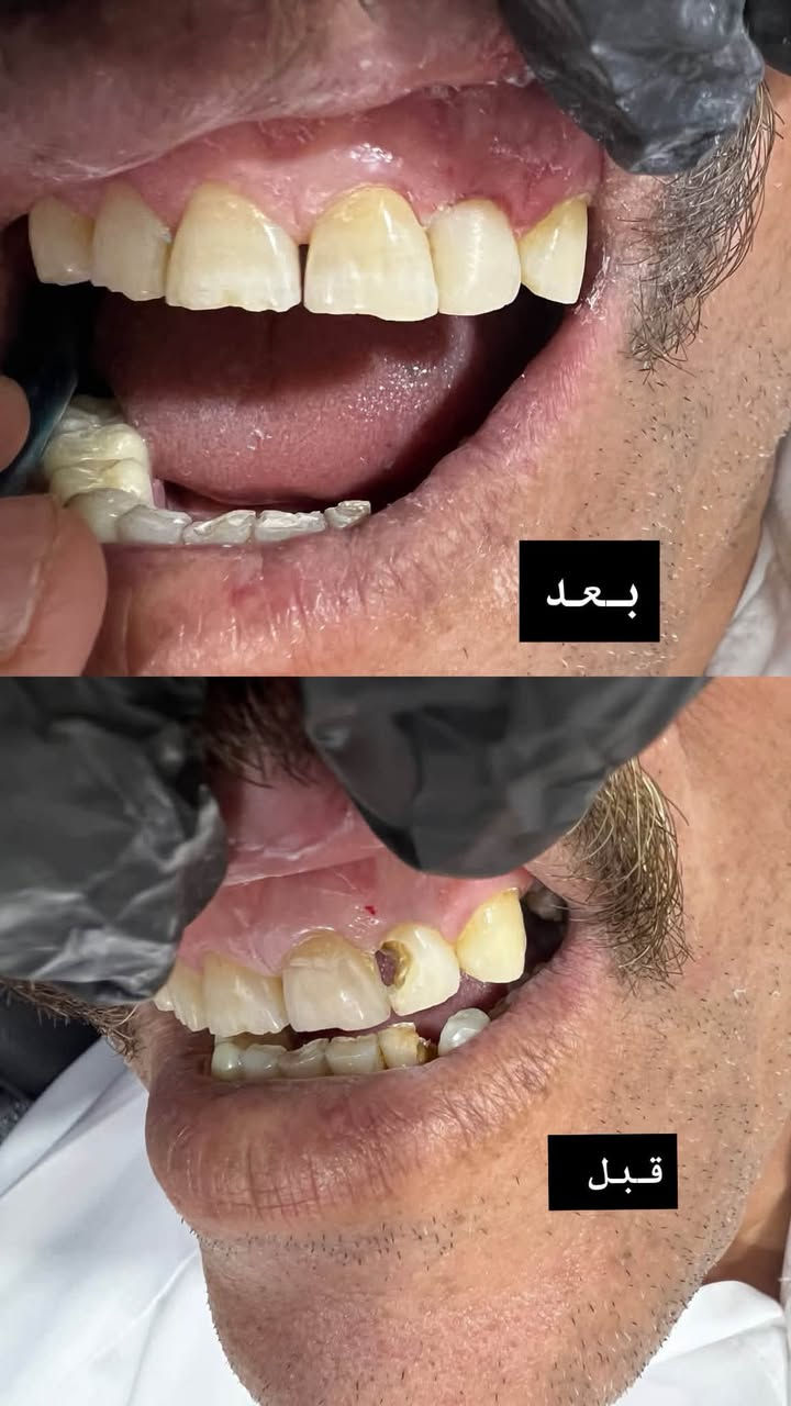 النجف الاشرف / شارع الإسكان
قرب مستشفى الزهراء
علما العلاج مجاني
للحجز مراسلت الواتساب لطفاً
***********

نص مكتوب في الصور:
- تم فتح الحجز في عيادات الكفيل النجف الاشرف / شارع الإسكان / قرب مستشفى الزهراء للحالات الاتيه: تنظيف الأسنان وأزالة التكلات القويه (الي عدهم التهاب باللثه وتورم ونزف) قلع الأسنان التالفة والجذور المتبقية واسنان العقل والقلع الجراحي علاج اسنان الاطفال (قلع حشوات وفلورايد وقائي) تعويض الاسنان بطقم كامل متحرك العلاج بالتقويم لبعض الحالات علاج أمراض وتقرحات الفم واللثة حشوات ضوئية تجميليه لجميع الاسنان علما العلاج مجاني للحجز *********** الدكتورة شيرين علي حسين
- قبل
- بعد