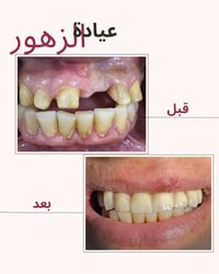 تركيبات أسنان • ابتسامة طبيعية • عيادة الزهور