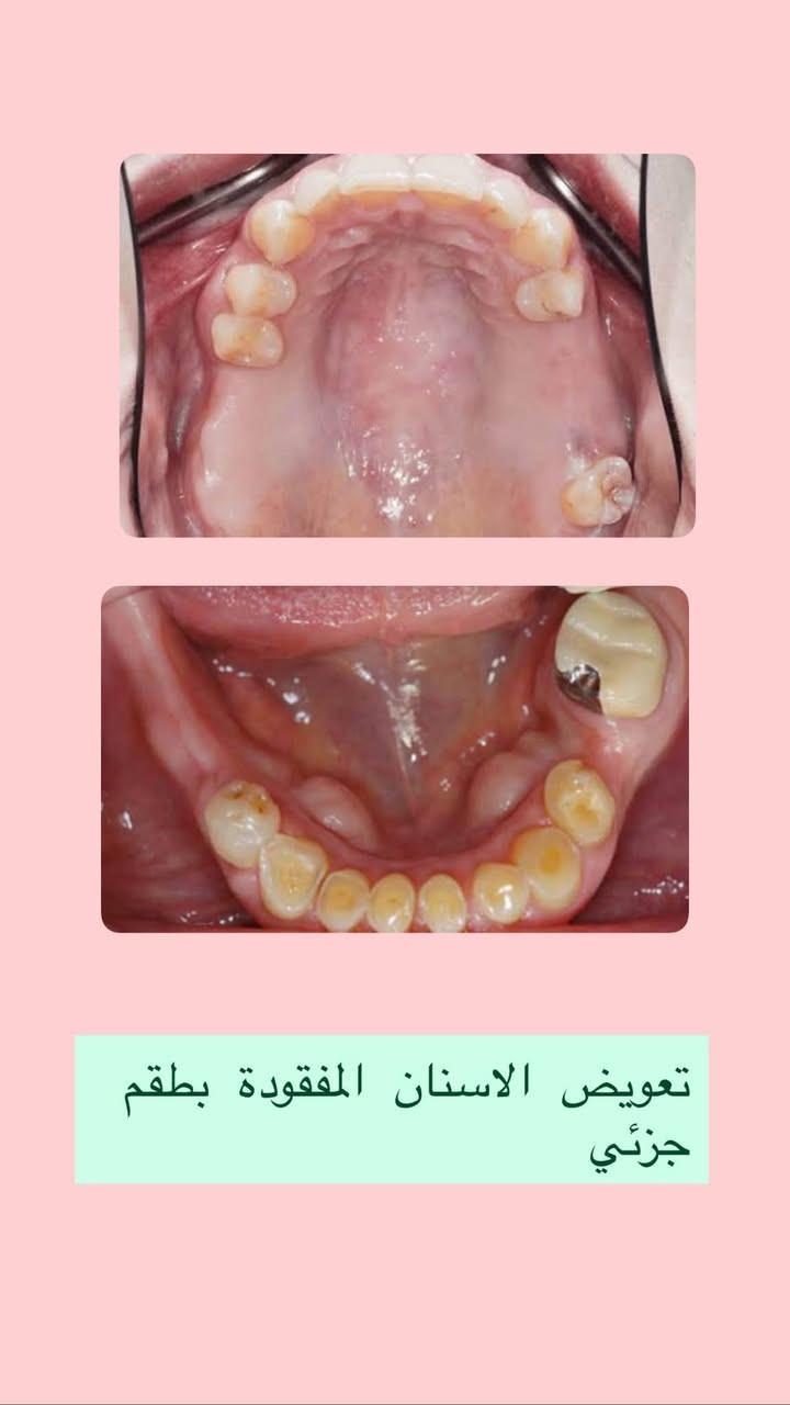 علاج مجاني • عيادات جامعة البيان • قلع اسنان