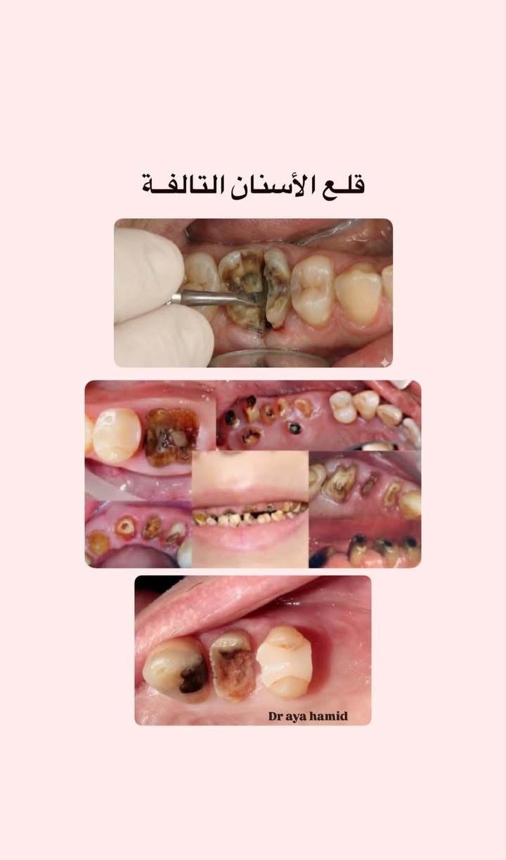 مجاناً مجاناً
السلام عليكم
انا طالبة طب اسنان اللي يحتاج
1. قلع للاسنان
﻿﻿﻿حشوات بيضاء تجميلية
﻿﻿﻿أطخم أسنان متحركة للاسنان المفقودة
﻿﻿﻿تنظيف للاسنان
خدمة مجاني بعيادة كلية النور الجامعة بحي الشلالات مقابل دجلة ستي
للتواصل عالواتس ***********
او علقو حسب حالتكم وانا اتواصل معاكم.

نص مكتوب في الصور:
- علاج التسوس بحشوات ( بيضاء ) تجميلية
- Dr aya hamid
- تنظيف الأسنان وإزالة التكلسات
- قلع الأسنان التالفة
- تعويض الأسنان المفقودة بطقم متحرك
- After
- Before