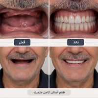 طقم أسنان • متحرك • مجاني