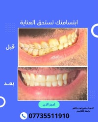 تنظيف اسنان • حشوة • قلع
