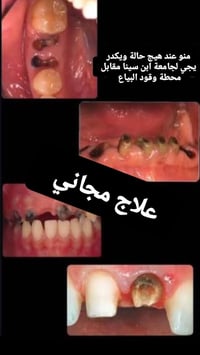 علاج مجاني • خدمات اسنان • جامعة ابن سينا