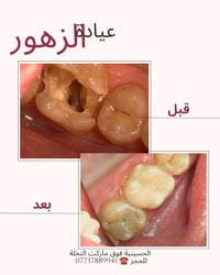 حشوات جذور • جلستين • ضمان ٥ سنوات
