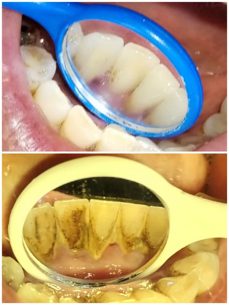 على بركة الله نعاود استقبال الحالات التالية في عيادات جامعة الحلة 🦷
-الحشوات الضوئية (الحشوة البيضاء)
_تنظيف الاسنان وازالة التكلسات 
_قلع الاسنان التالفة والجذور المتبقية
_تعويض الاسنان المفقودة بطقم كامل
_قلع وحشوات ومعالجة اسنان الاطفال

🔴العلاج بشكل شبه مجاني 

الموقع🔻 :شارع اربعين،مجاور صيدلية سلامتك

للحجز والاستفسار📞: ***********

نص مكتوب في الصور:
- Before