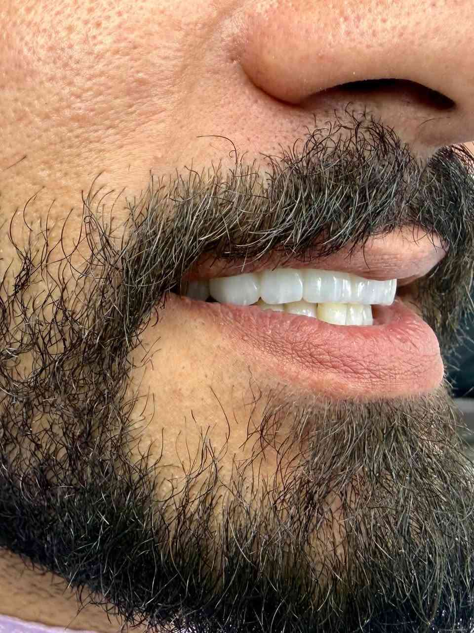 بس  ثبّتوا حجزكم ويانا 😍🔥

والباقي خلّوه علينا!
نخطط، نرسم، ونهتم بكل التفاصيل حتى نطلعلكم ابتسامة تفرحون بيها كل يوم 🤍🦷

وشغلنا عليه ضمان من ٥ سنوات وفوك

كادر متخصص متواجد يوميا من ساعة ٤-٩ 
تنورونا دائما 

#اكسبلور #explore #الشعب_الصيني_ماله_حل😂😂

نص مكتوب في الصور:
- الابتسامة يمنا غير شكل مو بس قالب ونثبته الابتسامة يمنا تفاصيل وشفافية وجمالية تخلي ثقتك بنفسك تزيد كل يوم الزاركون المدمج بالايماكس ب ٩٠ الف فقط للسن الواحد الزاركون ب ٧٠ الف للسن الواحد ***********
- كل الي عليكم تثبتون حجزكم يمنا واحنا الي نخطط ونرسم ونهتم بكل النواحي ضمان بالعمل من 5 سنوات فما فوق