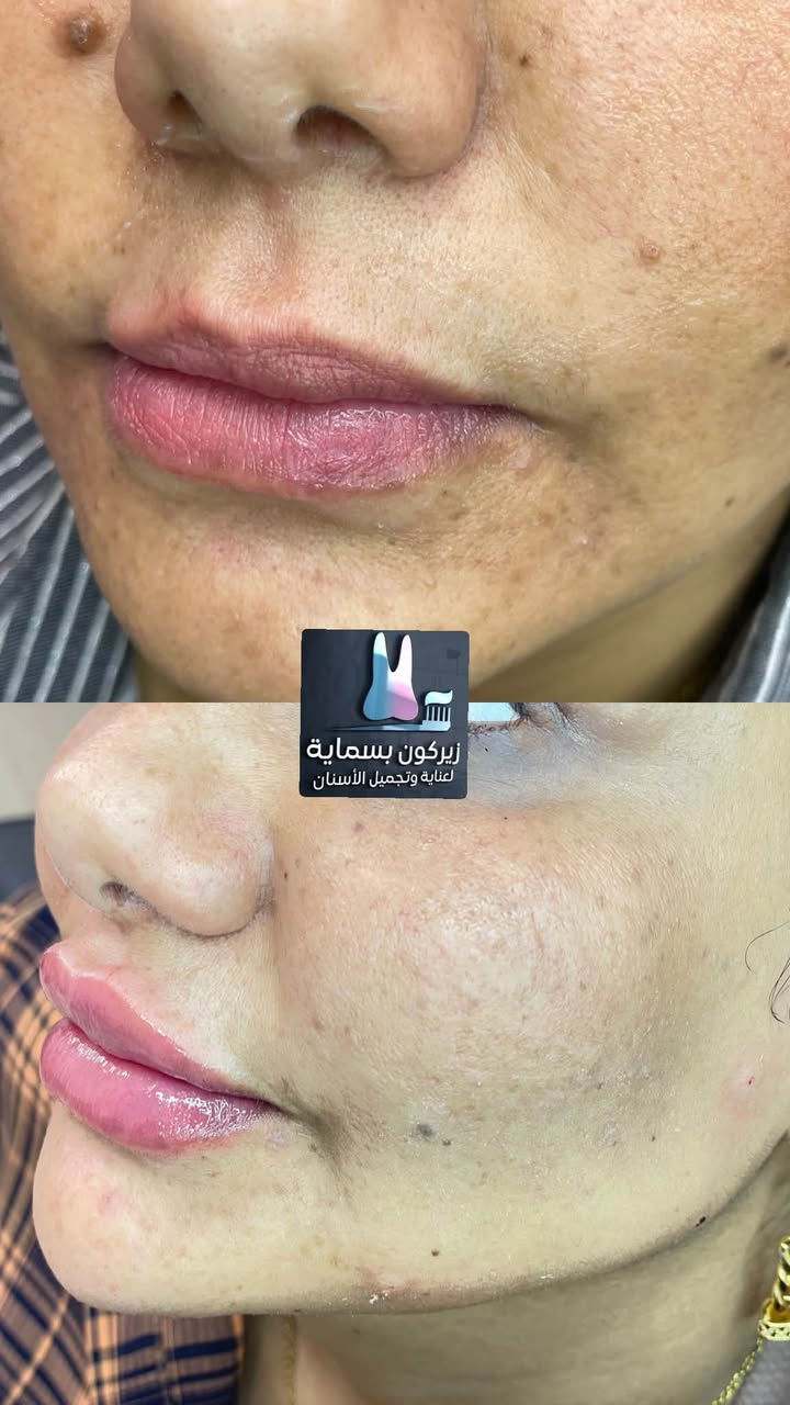 زيركون بسماية
نظام التقسيط يشمل جميع الاقسام وبدون مقدمة

والفحص مجانا 🥰

✨ جمالكِ مُهمتنا…..
شفايف منحوتة بعناية… امتلاء ناعم بدون مبالغة 💋
نتيجة طبيعية تخلي الكل يلاحظ بدون ما يعرف السر .

الدكتورة زهراء نجاح الحسيني حاصلة على سرتفكيت في تجميل الوجه اللاجراحي

علماً ان جميع المواد المستخدمة من براندات ووكالات عالمية ومرخصة من وزارة الصحة العراقية
———————————————————
بغداد-مقابل باب مجمع بسماية الالكتروني B الخدمي الراجع من بغداد عمارة كافي حنوش
مجاور صيدلية مريم عامر 

  للحجز+اسفسار
0775746377

#بسماية #تجميل #فلر

نص مكتوب في الصور:
- شكل شفة غير متناسق عدلنه التناسق وضفنه حجم حلو للمراجعة وطلعت باحلى صورة 🥰❤️
- بنات وفرتلكم احدث فلر كوري امتياز بعالم التجميل يبقى طري وينطي احلى رسمة ممكن تحصولها سعر العرض ب90 الف فقط 🔥❤️
- بعد قبل
- رسمة جديدة مكبوسة وحجم حلو حسب ذوق المراجعة الحلوة❤️
- لعناية وتجميل الأسنان
