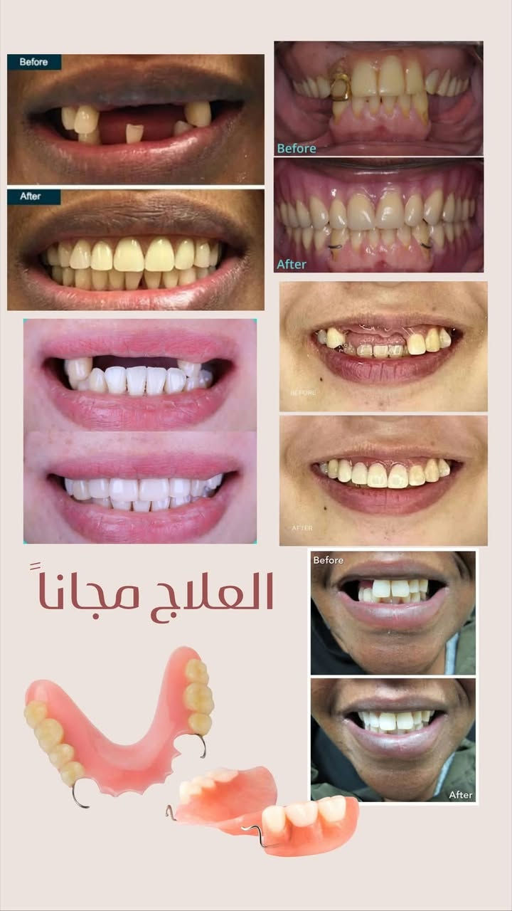 طقم اسنان متحرك • مجانا • بغداد حي القاهرة