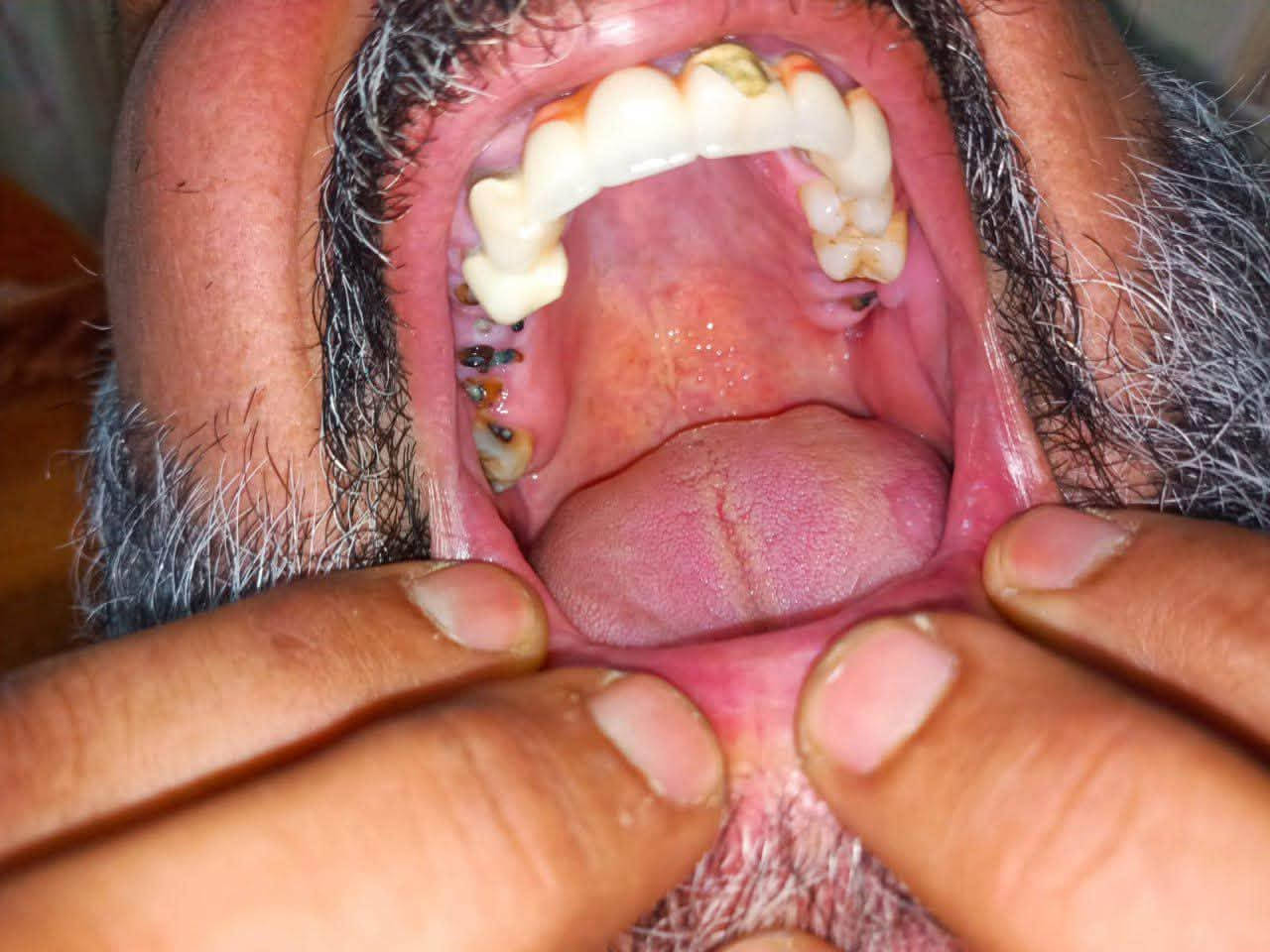 السلام عليكم
يتوفر علاج مجاني للاسنان تحت اشراف دكاترة اختصاص في عيادات جامعة اوروك طب الاسنان 
• حشوات ضوئية وتجميلية
• تنظيف وازالة التكلسات
• قلع الاسنان المتضرره والجذور المتبقية
• تنظيف وحشوات وقائية للاطفال
• اطقم اسنان كاملة لكبار السن
• جسور و تلبيسات للاسنان 
التواصل: ***********
التلگرام: @Sa3f17
الموقع: الكرادة شارع 52
