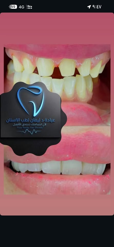 التعقيم: نطبق أعلى معايير منظمة الصحة العالمية لضمان سلامتك.
التقنيات: نستخدم الأشعة الرقمية (Digital X-Ray) لتقليل الانبعاثات وزيادة دقة التشخيص.

​الراحة: كادر طبي متعاون وبيئة هادئة بعيدة عن التوتر.

​المتابعة: لا تنتهي علاقتنا بك بانتهاء الجلسة، بل نتابع معك لضمان استدامة النتائج.

​📞 للحجز والاستفسار:

​📍 العنوان: [ - كركوك الحويجة حي الثورة شارع البورصة..]

​📱 رقم الهاتف: [***********]

​🕙 أوقات الدوام: متواجدين 24ساعة على مدار أليوم شوكت متجي حياك الله 

​دليڤان لطب الأسنان.. لأنك تستحق أن تبتسم بثقة!🦷
