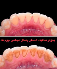 عيادة العلاوي • شارع ٦ • تنظيف اسنان مجاني