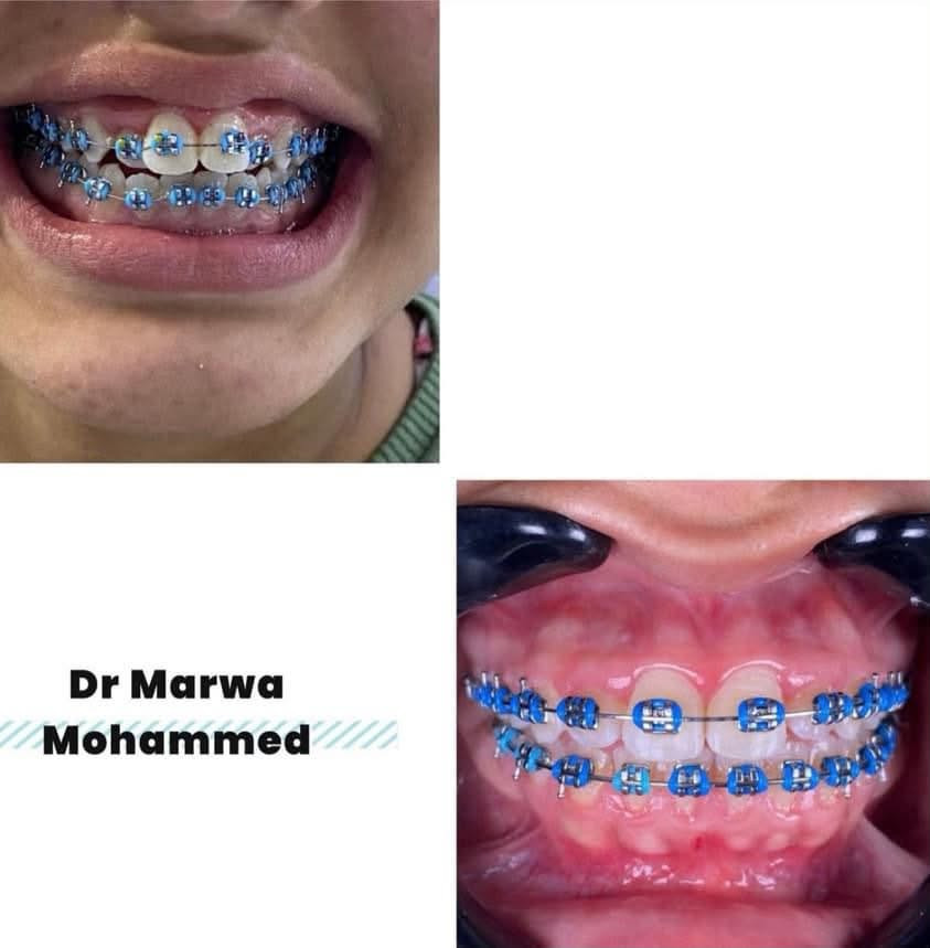 تقويم الأسنان
د. مروة محمد طالب 
للتواصل ع الرقم
***********
