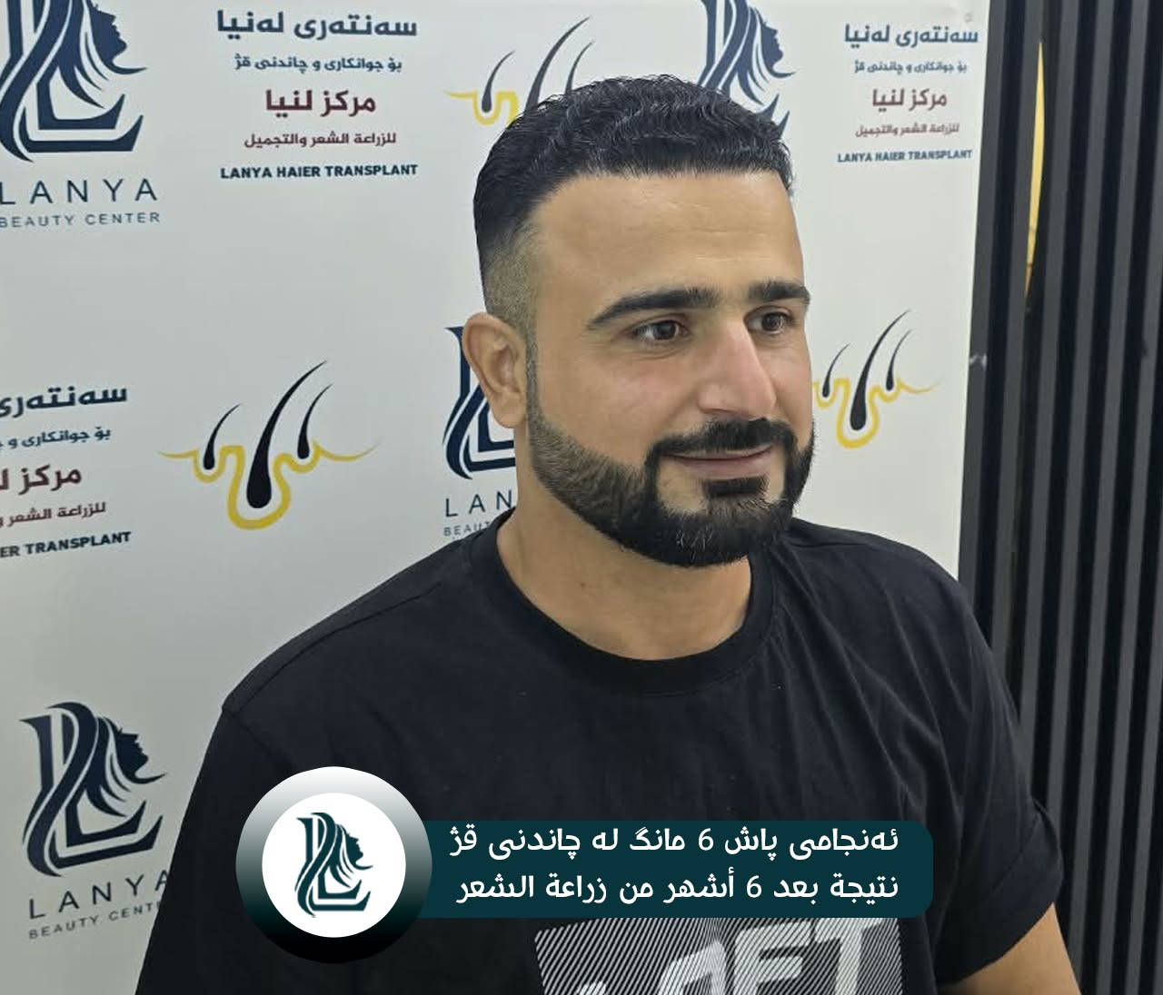 استعد كثافة شعرك من جديد! 
في مركز لەنيا للتجميل و زراعة الشعر ، نساعدك على استعادة مظهر الشعر الطبيعي والأكثر كثافة من خلال زراعة الشعر.
🌿 نتائج طبيعية | 👨‍⚕️ خبرة واحترافية | ✨ عناية بأدق التفاصيل
لەنيا — لأن جمالك يستحق الأفضل. 🤍
♦ مع لەنیا حافظ على شبابك.
📍 العنوان:كلار - شارع ليوا - قرب جامع بخاري
📞 رقم التواصل:
***********
--------
قژێکی پڕتر، متمانەیەکی زیاتر! 
لە سەنتەری جوانکاری لەنیا، بە چاندنی قژ هەنگاوێک بەرەو قژێکی جوانتر و سروشتی‌تر بنێ.
🌿 ئەنجامی سروشتی | 👨‍⚕️ پسپۆڕی | ✨ گرنگیدان بە وردەکاری
♦ لەگەڵ لەنیا هەمیشە بەگەنجی دەمێنێتەوە
📍 ناونیشان: کەلار- شەقامى لیواکە - نزیک مزگەوتی بوخاری
📞 ژمارەی پەیوەندی: ***********
