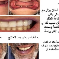 طقم جزئي متحرك • تركيب أسنان • جامعة بلاد الرافدين