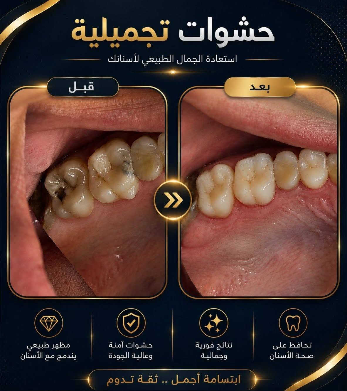 ابتسامة أحلامك وإطلالة أنيقة تبدأ من هنا! ✨🦷💖
يسعدنا في [عيادة الوسامة] استقبالكم وتقديم أرقى الخدمات الطبية والتجميلية بخبرة عالية واهتمام خاص.

​💎 خدمات طب الأسنان:
​تبييض الأسنان بالليزر للحصول على ابتسامة هوليوود ناصعة.
​زراعة وتلبيس الأسنان بأفضل الخامات العالمية.
​تقويم الأسنان وعلاج اللثة.
​العلاج التجميلي والترميمي بدون ألم.

​🌸 خدمات التجميل :
​جلسات النضارة 
ابر (فيلر، بوتوكس).

​أحدث تقنيات شد وتجديد شباب الجلد.
​📍 العنوان: 
[بغداد _ السيدية _ شارع الخيزران بجانب مازن كيتو]
📞 للحجز والاستفسار: 
​***********
​***********
💬 أو راسلونا مباشرة عبر الصفحة لتحديد مواعيدكم.

نص مكتوب في الصور:
- عيادة الوسام
- الدكتور
- محمود سامي الزبيدي
- لطب وتجميل الأسنان
- ***********
- ***********
- السيدية شارع الخيزران مجاور مندي
- بوابة اليمن وقابل قهوة ساو
- ابتسامة جديدة ثقة تدوم في عيادة الوسامة نهتم بكل تفاصيل ابتسامتك لنتائج طبيعية وتدوم طويلاً قبل بعد نتائج طبيعية ومضمونة مواد عالية الجودة وآمنة تكنولوجيا حديثة ودقة في العمل ابتسامة جميلة تغير حياتك للحجز والاستفسار *********** *********** عيادة الوسامة بغداد _ السيدية
- حشوات تجميلية استعادة الجمال الطبيعي لأسنانك قبل بعد تحافظ على صحة الأسنان نتائج فورية وجمالية حشوات آمنة وعالية الجودة مظهر طبيعي يندمج مع الأسنان ابتسامة أجمل .. ثقة تدوم