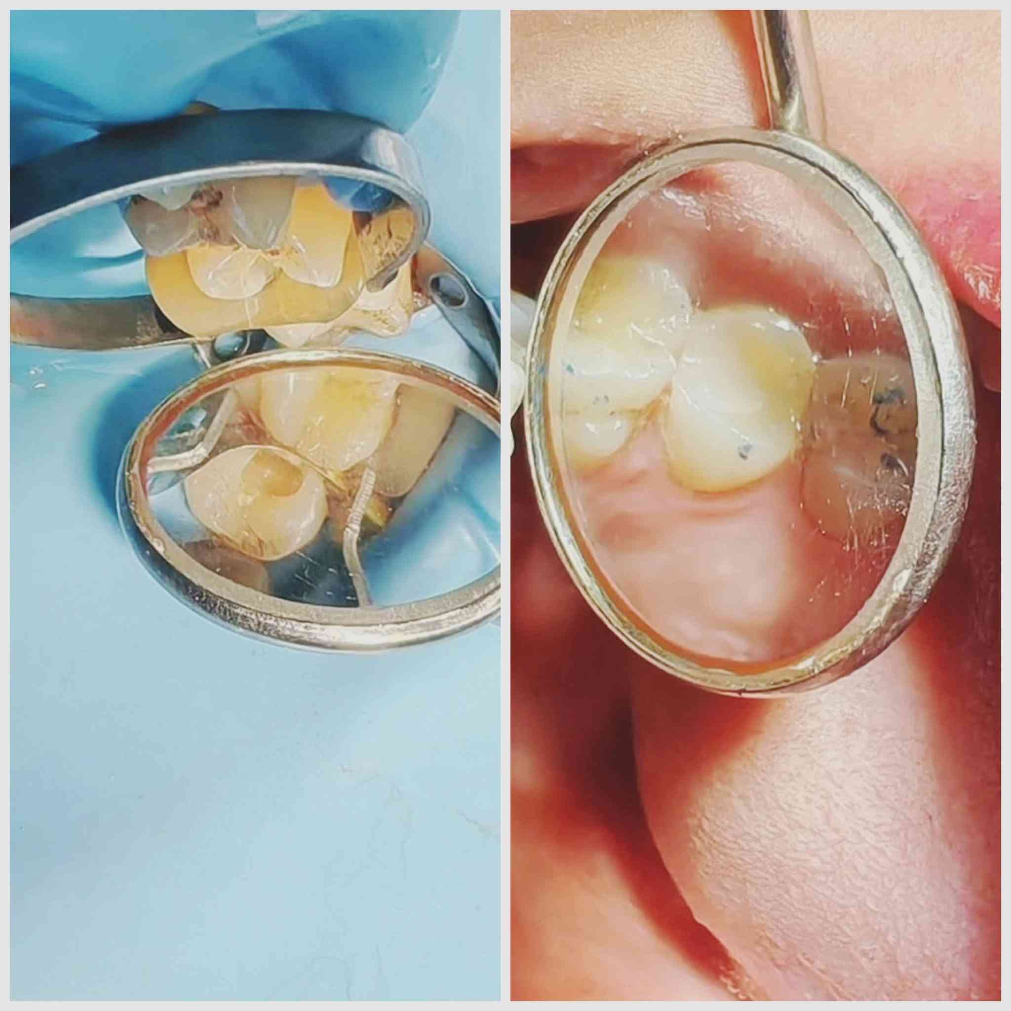 🦷 تحتاج علاج أسنان؟ نوفر لك العلاج داخل العيادة الجامعية

تتوفر حاليًا إمكانية استقبال المرضى لعلاج عدد من حالات الأسنان، بإشراف أطباء وأساتذة الاختصاص.

🔹 تنظيف وتبيض الأسنان
🔹 حشوات الأسنان الخلفية لكافة انواع تسوس 
🔹 حشوات تجميلية لعلاج كسر او تسوس الاسنان الامامية. 
🔹 علاج أسنان الأطفال
🔹فحص و علاج امراض اللثة والفم
🔹 خلع الأسنان عند الحاجة
🔹 تخم الأسنان المتحرك اذا كنت فاقد جميع الاسنان . 
🔹 حالات أخرى بعد الفحص والتقييم

📍 المكان: المستشفى التعليمي – كلية طب الأسنان جامعة بلاد الرافدين - بعقوبة -قرب تقاطع القدس. 

💰 العلاج: مجاني فقط سعر الباص. 

إذا كنت تحتاج علاجًا أو تعرف شخصًا يحتاجه، ضمن الصور المرفقة راسلنا على الخاص وأرسل:
📸 صورة الأسنان إن أمكن
📍 المنطقة
📞 رقم للتواصل

الأولوية للحالات المناسبة للإجراءات المتوفرة حاليًا.

🦷 صحتك تبدأ بخطوة بسيطة… احجز موعدك للفحص.

نص مكتوب في الصور:
- كلية طب الاسنان جامعة بلاد الرافدين رعاية متكاملة لصحة الفم والاسنان خدماتنا حشوات تجميلية وعلاج التسوس تنضيف و تلميع الأسنان قلع الاسنان علاج أسنان الأطفال صناعة وتركيب اطقم أسنان للحجز *********** ديالي,بعقوبة,قرب تقاطع القدس المستشفى التعليمي كلية طب الأسنان لجامعة بلاد الرافدين