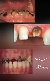 علاج مجاني • قلع أسنان • جامعة الكوت