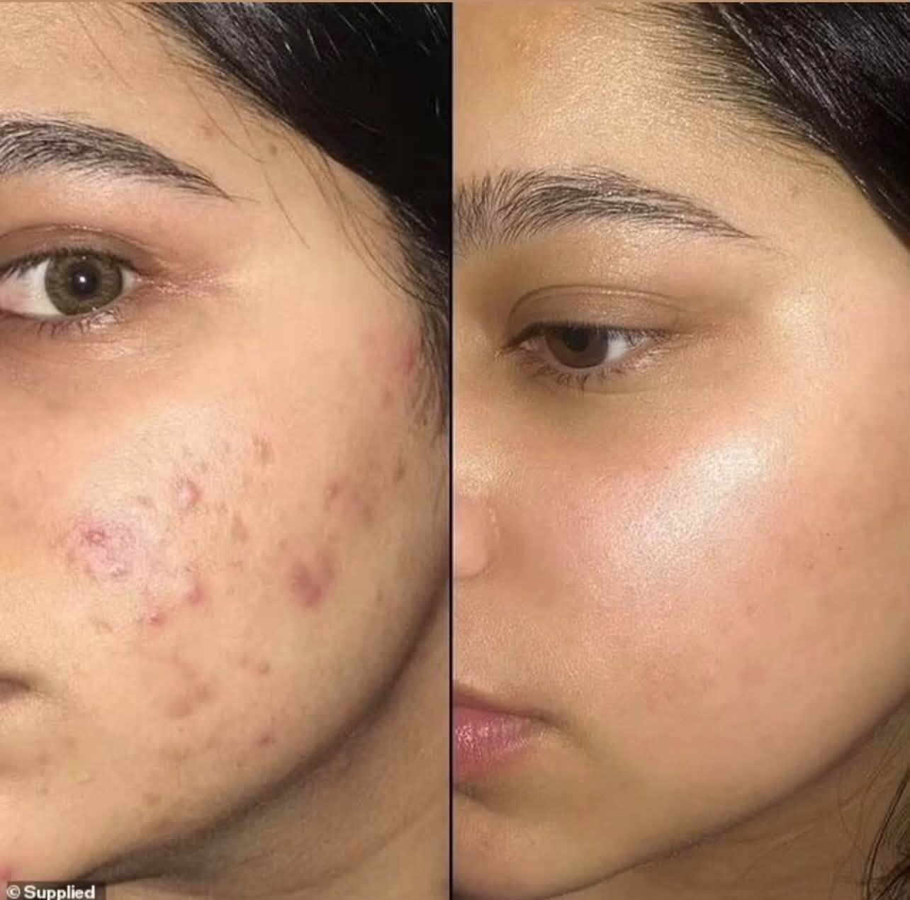 ‎بنات اقسم بالقرآن  وع كل حرف  اكوله وان شاء الله  
‎بعافيتي وبصحتي ا🤩ذا اغشكم بنات اسوي زيت للشباب وللببنات شعر يفور فورررررر عليه انسي بعد شي حرك من صبغ انسي بعد  قصير انسي شي تساقط لي دتطلب علبة دترجع نوب تاخذ بنات يموووت انصحكم بي  ثقو بالله ددمرون شعركم بالمنتجات بنات هذا جربو وادعولي واني بيدي اسوي الخلطة وتوصيل مجاني كذلك واسوي خلطه للوجه اكسر بيها ابر تبيض ونضارة وشد الله شاهد على كلامي

نص مكتوب في الصور:
- خلطة الكولاجين للبشرة - نضارة وتبييض
- فوائدها تخبل:
- - تبيض البشرة وتنطي نضارة ولمعة من اول استعمال
- - تشيل الكلف والتصبغات وتوحد اللون
- - تشد الوجه وتشيل التجاعيد والخطوط الرفيعة
- - ترجع الشباب للبشرة وتحارب الشيخوخة
- - ترطب بعمق وتنطي لمعة صحية تجنن
- - بيها كولاجين صافي يغذي البشرة ويجددها
- استعملهاها: بالليل على بشرة نظيفة، شوية منها ودلكيها لحد ما تمتصها البشرة
- للحجز والاستفسار
- ***********
- منتج طبيعي • آمن للبشرة
- Supplied
- BEFORE AFTER
- دليل النتائج: تصحيح الملمس العميق
- قبل التدخل العلاجي (احمرار، حبوب نشطة، ملمس خشن)
- دليل النتائج: القضاء على البثور المتراكمة
- الحالة: تراكم البثور وآثار الحبوب على منطقة الخد والفك.
- النتيجة: استعادة نعومة السطح وتوحيد لون البشرة بالكامل دون ترك ندبات.
- The Botanical Clinic
- ملف عميل: "تأثير إبرة النضارة"
- "سويت إبرة مالت نضارة.. وجهي صار يجنن والخلطة عالجته. هذا السيروم أحسن من اللي قبله، التبييض يجنن وصدق مضبوطة."
- شهادة حقيقية لنتائج تتجاوز التوقعات.