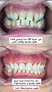تقويم+حشوات • سوء الإطباق • عيادة عبد الوهاب