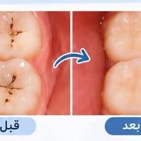 علاج تسوس مجاني • كلية طب الاسنان • اشراف اطباء