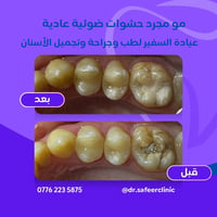 حشوات ضوئية • ابتسامة صحية • عيادة السفير