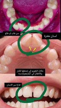 تقويم اسنان مجاني • شارع 40 • من ١٥ سنة