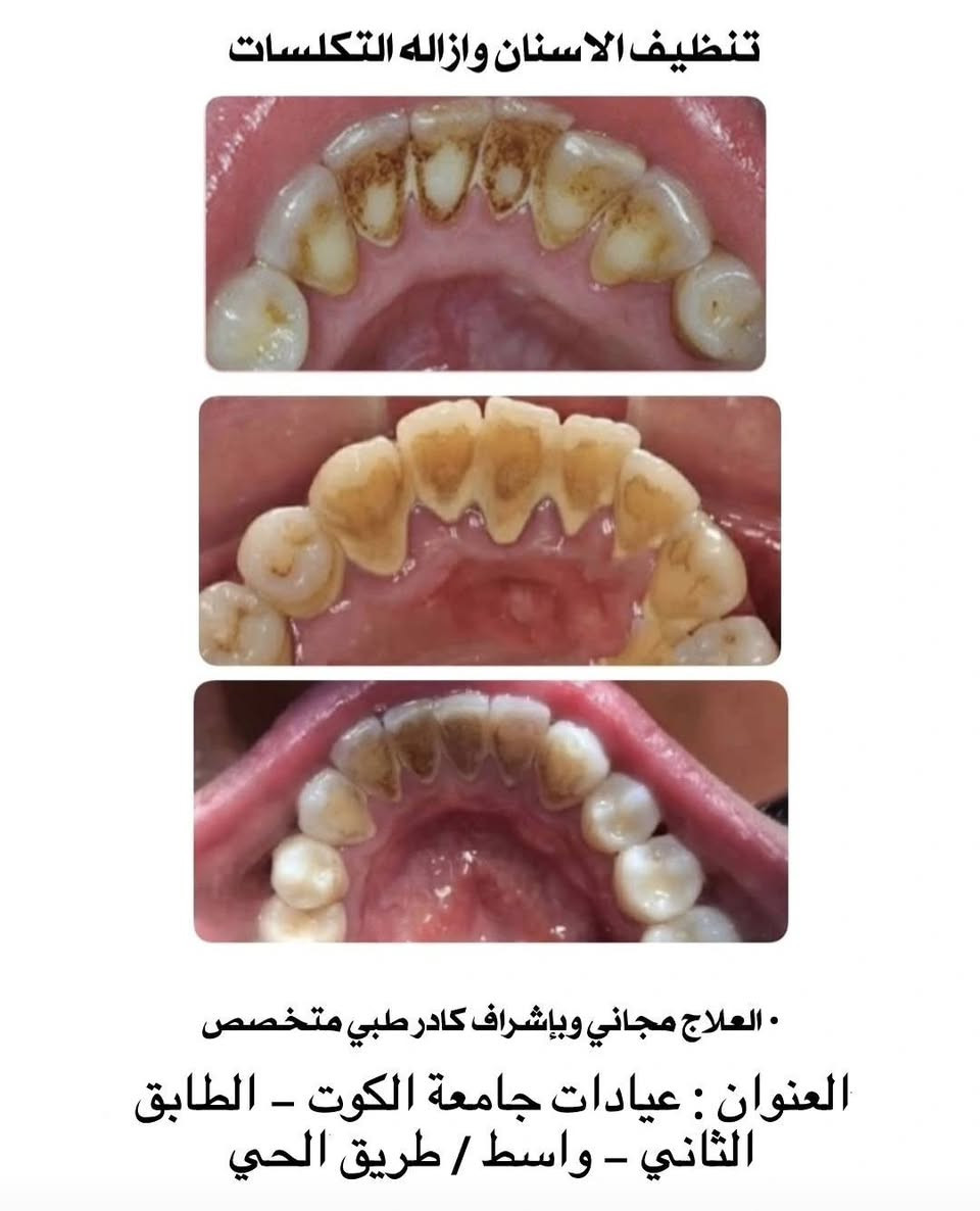 علاج مجاني • جامعة الكوت • حشوات تجميلية