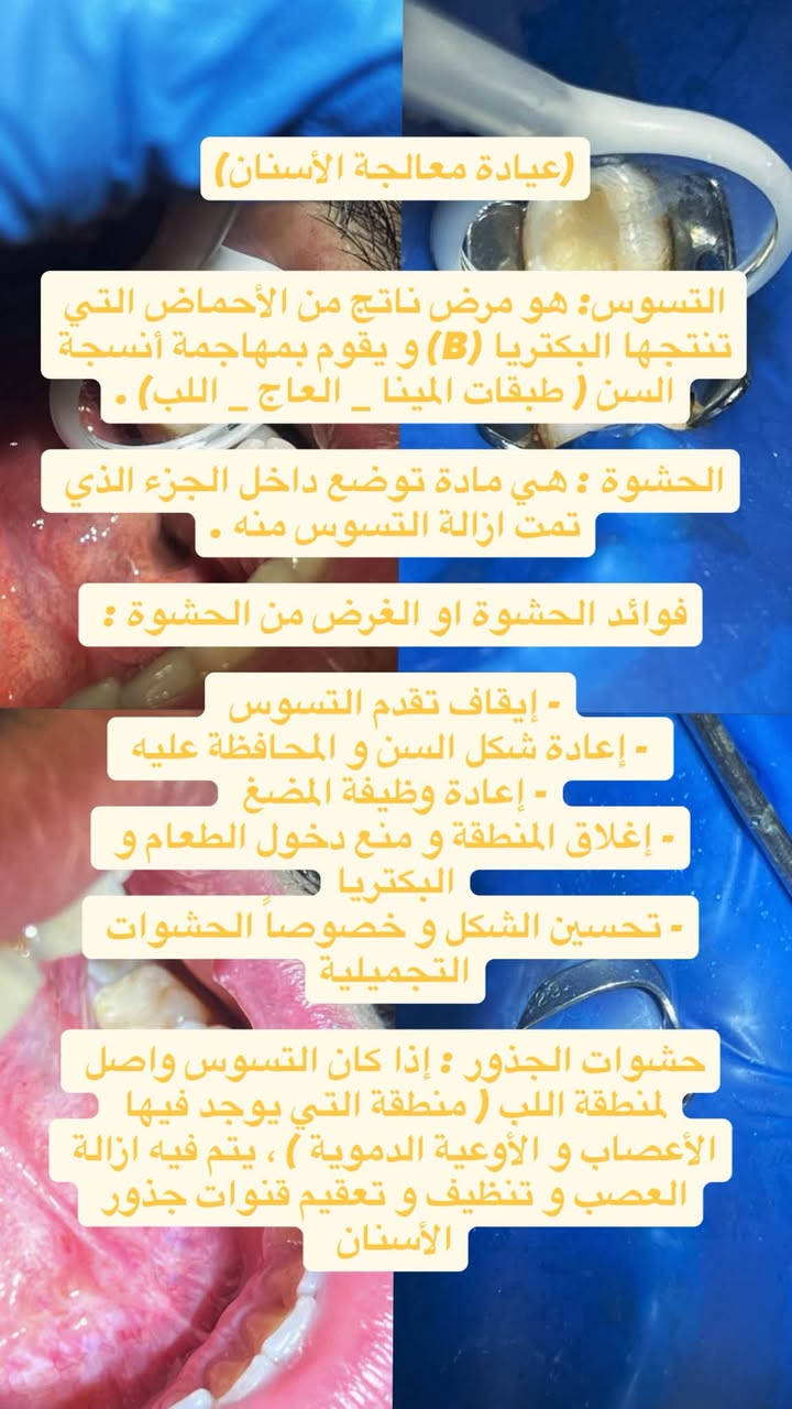 مجاناً • حشوات تجميلية • جامعة الفراهيدي