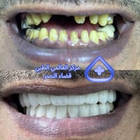 تجميل أسنان • قبل وبعد • قضاء النصر
