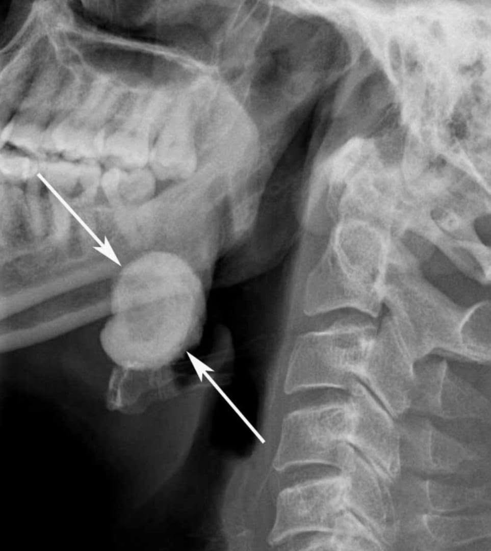 🩻 دور الأشعة الرقمية DR في تشخيص حصوات الغدد اللعابية
هل تعاني من ألم أو تورم في منطقة الفك أو تحت اللسان، خصوصًا أثناء تناول الطعام؟
قد تكون هذه الأعراض مرتبطة بوجود حصوات في الغدد اللعابية.
🔍 تساعد الأشعة الرقمية DR في الكشف عن بعض حصوات الغدد اللعابية، خصوصًا الحصوات التي تحتوي على نسبة عالية من الكالسيوم وتظهر بوضوح في صورة الأشعة.
📌 أهم الأعراض التي تستدعي الفحص:
• تورم متكرر في الغدة اللعابية. 
• ألم يزداد أثناء تناول الطعام. 
• جفاف الفم أو صعوبة في إفراز اللعاب. 
• ألم أو انتفاخ أسفل الفك أو تحت اللسان. 
✨ التصوير بالأشعة الرقمية يتميز بـ:
✅ سرعة إجراء الفحص. 
✅ وضوح ودقة الصورة. 
✅ إمكانية المساعدة في تحديد موقع الحصوة. 
✅ دعم الطبيب في اختيار الإجراء التشخيصي أو العلاجي المناسب. 
📍 عيادة العامل للأشعة الرقمية DR
دقة في التصوير… وسرعة في النتائج… وثقة في التشخيص.
🩻 إذا كنت تعاني من أعراض متكررة، فالفحص المناسب يساعد في الوصول إلى التشخيص الصحيح.
صحتكم.. اهتمامنا
متواجدين طيلة ايام الاسبوع مع يوم الجمعة من الساعة(4-8) مساءً بوجود كادر نسائي متمرس والعيادة طابق ارضي
حي العامل.. السوق الشعبي.. شارع الأطباء.. مجاور صياغة الزيدي.. مقابل مكتب السيد الشهيد محمد صادق الصدر (قدس سره) 
للاستفسار الاتصال على الرقم :***********

