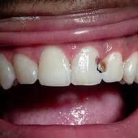 تسوس • علاج مجاني • عيادة جامعة كربلاء