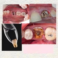 علاج أسنان مجاني • حشوات ضوئية • كلية أصول العلم