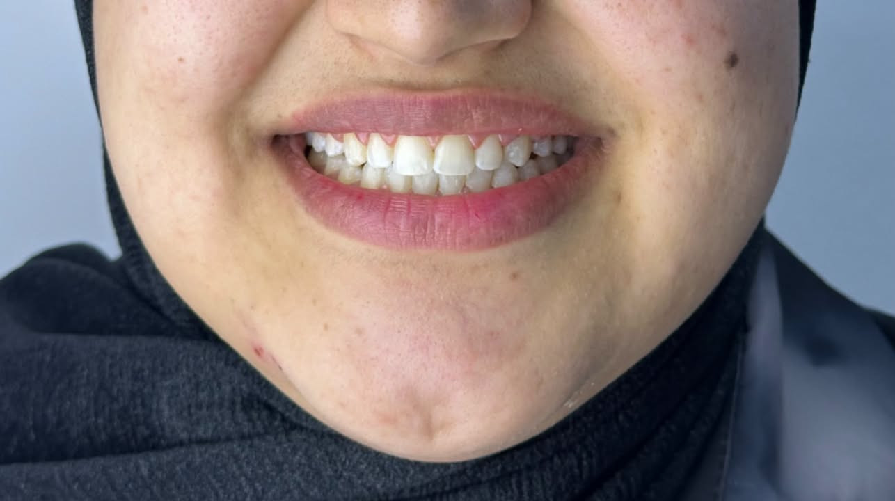 “من فراغات واضحة إلى ابتسامة متناسقة ✨🦷
بعد إكمال علاج التقويم تم إغلاق الفراغات وتحقيق اصطفاف أفضل للأسنان، لتكون النتيجة ابتسامة طبيعية وأكثر جمالًا. 🤍 
الدكتورة هاجر عدنان

نص مكتوب في الصور:
- Dr.hajer adnan