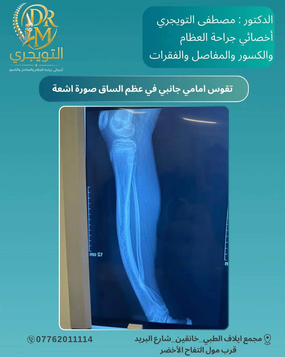 🧬✨ مو كل علامة على الجلد تكون بسيطة… 

الورم الليفي العصبي من النوع الأول (Neurofibromatosis ) هو مرض وراثي يمكن أن يؤثر بشكل رئيسي على الجلد الأعصاب العظام والعينين 🧠🦴👁️ 

التشخيص المبكر والمتابعة الطبية يساعدان على اكتشاف التغيرات ومتابعتها بشكل أفضل ❤️‍🩹 

🔎 الوعي بالمرض… أول خطوة نحو رعاية أفضل.
الدكتور : مصطفى التويجري
أخصائي جراحة العظام والكسور والمفاصل 👨‍⚕️ 

📞 للحجز والاستفسار تواصل معنا الآن
📞 *********** 

📍 العنوان: مجمع إيلاف الطبي _ ديالى خانقين _ شارع البريد _ قرب مول التفاح الأخضر 

✨ رعايتك تبدأ بخطوة… وخطوتك الأولى هي الاستشارة الصحيحة. 

#الدكتور_مصطفى_التويجري
#مجمع_إيلاف_الطبي #خانقين
#الورم_الليفي_العصبي 
#Neurofibromatosis
