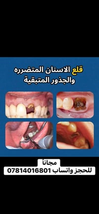مجانا • قلع الاسنان • جذور متبقية