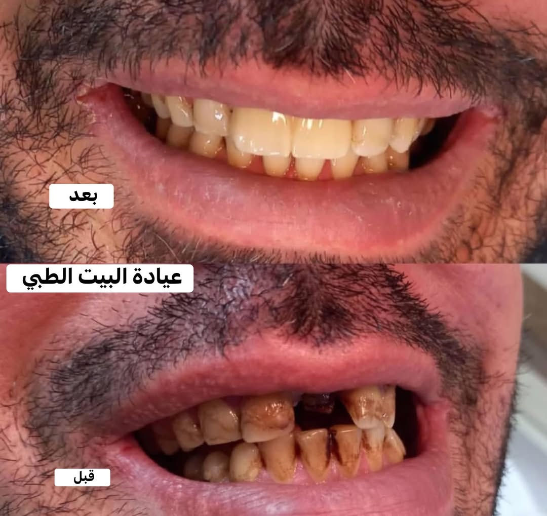 زيركون • أسنان ثابتة • عيادة البيت الطبي