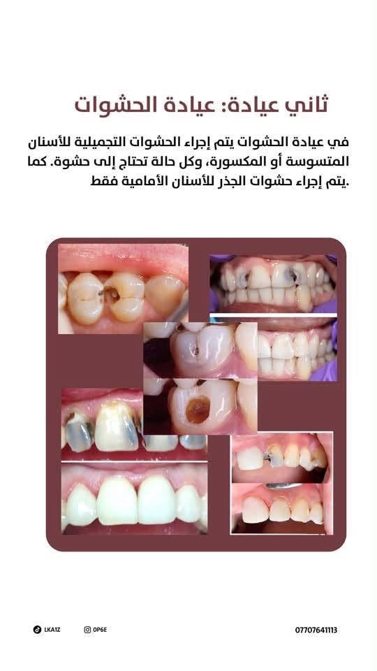 لا توجد تفاصيل

نص مكتوب في الصور:
- وراح تكون كل العيادات مجانية بالكامل وتحت اشراف مختصين تعالوا وياي اكلكم شنو راح نسوي LKAIZ OPGE ***********
- تتكون من عدة عيادات عيادة الحشوات عيادة الجراحة عيادة أمراض اللثة والتنظيف عيادة البروس او عيادة التعويضات السنية او التركيبات عيادة التقويم للاطفال عيادة الأطفال عيادة الأطفال الوقائية LKA1Z OP6E ***********
- أول عيادة: عيادة الجراحة في عيادة الجراحة يتم إجراء قلع الأسنان والجذور المتبقية، بالإضافة إلى القلع الجراحي للحالات التي تتطلب تدخلاً جراحياً، مثل قلع أضراس العقل وغيرها من الحالات. ***********
- ثاني عيادة: عيادة الحشوات
- في عيادة الحشوات يتم إجراء الحشوات التجميلية للأسنان المتسوسة أو المكسورة، وكل حالة تحتاج إلى حشوة. كما يتم إجراء حشوات الجذر للأسنان الأمامية فقط.
- LKA1Z
- OP6E
- ***********
- ثالث عيادة: عيادة البروس او عيادة التعويضات السنية او التركيبات في العيادة يتم العمل على الأطقم المتحركة لتعويض الأسنان المفقودة، سواء كان طقماً جزئيًا أو طقمًا كاملا. LKAIZ OP6E ***********