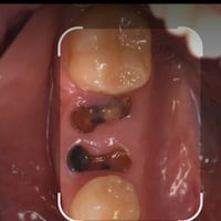 الي محتاج قلع الاسنان والجذور التالفة خلي يتواصل وياية على هذا الرقم 0...