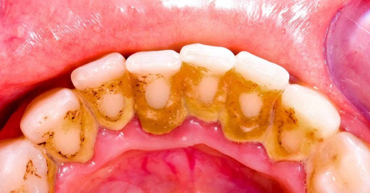 تعلن عيادات جامعة العميد لطب الاسنان عن استقبالها للمراجعين وتوفر حالات علاج الاسنان التالية :
تعلن عيادات جامعة العميد لطب الاسنان عن استقبالها للمراجعين وتوفر حالات علاج الاسنان التالية :
 قلع الاسنان والجذور المتبقية 

حشوة الاسنان التجميلة (البيضاء)

تعويض الأسنان المفقودة بطقم متحرك كامل وجزئي  
  حشوات الأسنان للأطفال 

  تنظيف الاسنان من التكلسات 

العمل  مجاني وتحت إشراف أطباء إختصاص لجميع الحالات  

واتساب ***********
